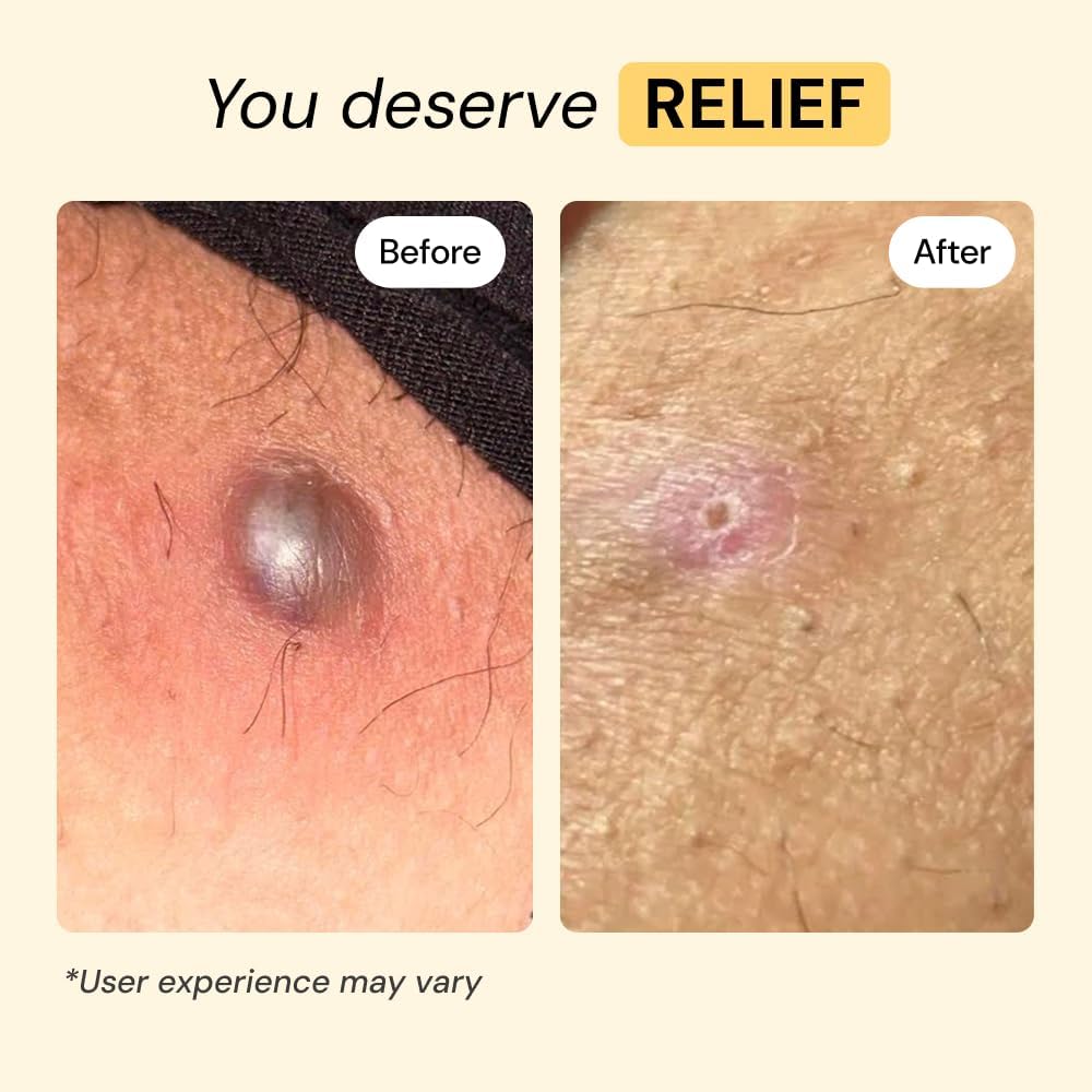 MyMagicHealer Universal Flare Care ?Multi-Purpose Solution | Skin Flare-Ups - Hidradenitis Suppurativa, Folliculitis, Boils, Cysts | Anti-Chafing | Irritated Skin Relief w/Propolis & Egg Yolk 1 oz