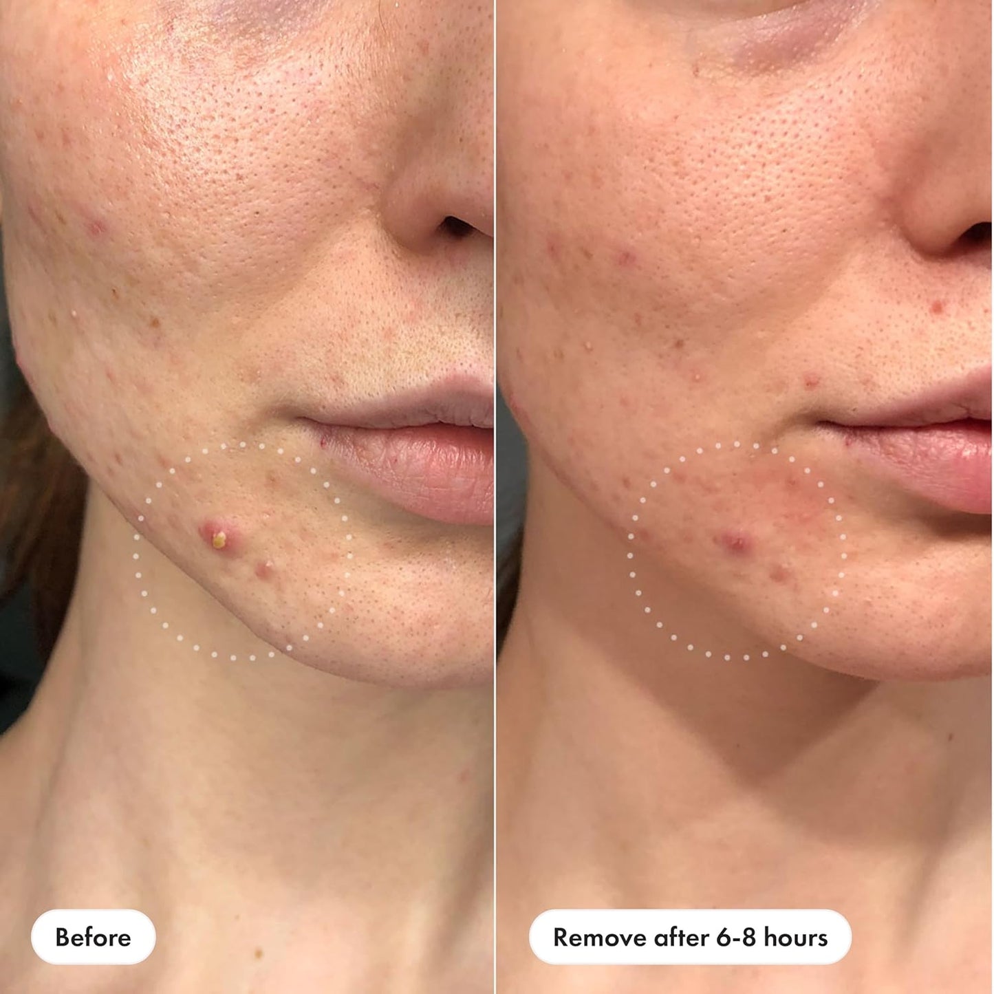 Mighty Patch?Invisible+ Patch ?The Barely-There Daytime Hydrocolloid Acne Pimple Patch for Covering Zits and Blemishes, Tapered Edges Designed to Blend Into Skin (72ct)